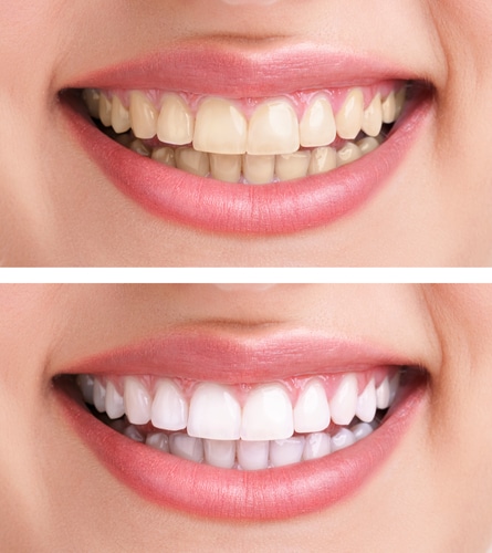 Teeth Whitening Before After Pictures Los Angeles Dentist