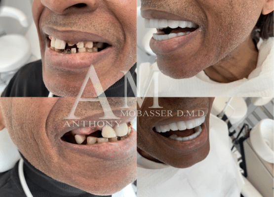 Celebrity Dentist Before & After Smile Makeover