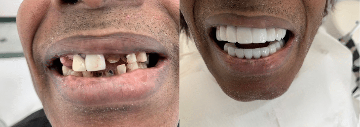 Celebrity Dentist Before & After Snap on Smile