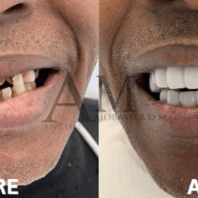 名人牙医贴面前后对比--洛杉矶的 "Snap-On "微笑 | 美容牙医 | 一天长出一口好牙