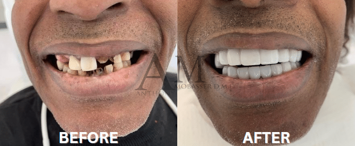 Dentista di celebrità Prima e dopo le faccette - Snap-On Smile a Los Angeles | Dentista cosmetico | Denti in un giorno