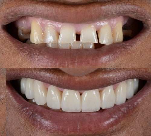 Dentiste esthétique à Los Angeles-Dr. Anthony Mobasser-Reconstruction de la bouche complète-Remise en état du sourire