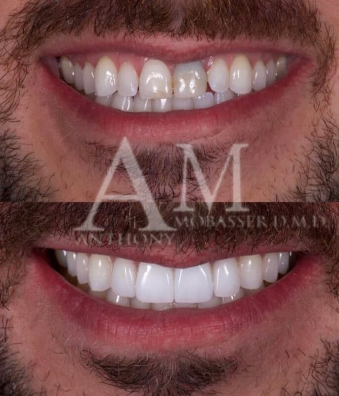 Rénovation du sourire avec 3 facettes et une couronne