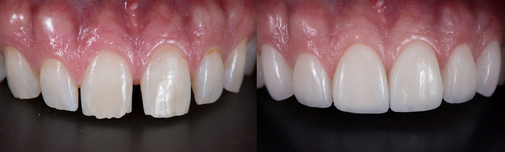 Los Angeles Dental Veneers The Secret Behind Celebrity Smiles