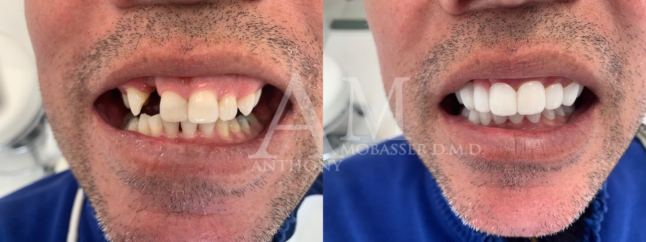 Transitional-Veneers-in-Los-Angeles---Dr.-Anthony-Mobasser-DMD
