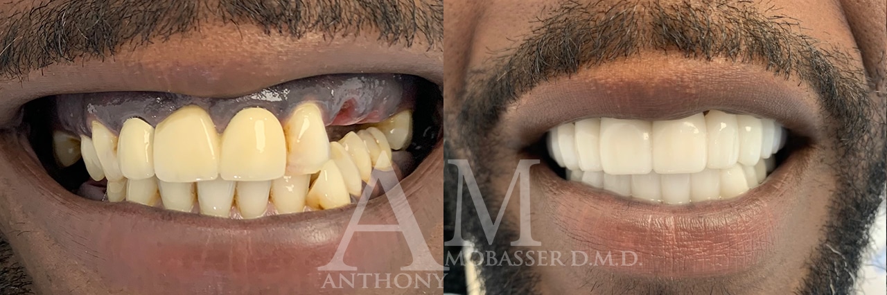 Transitional-Veneers-in-Los-Angles-Before-After