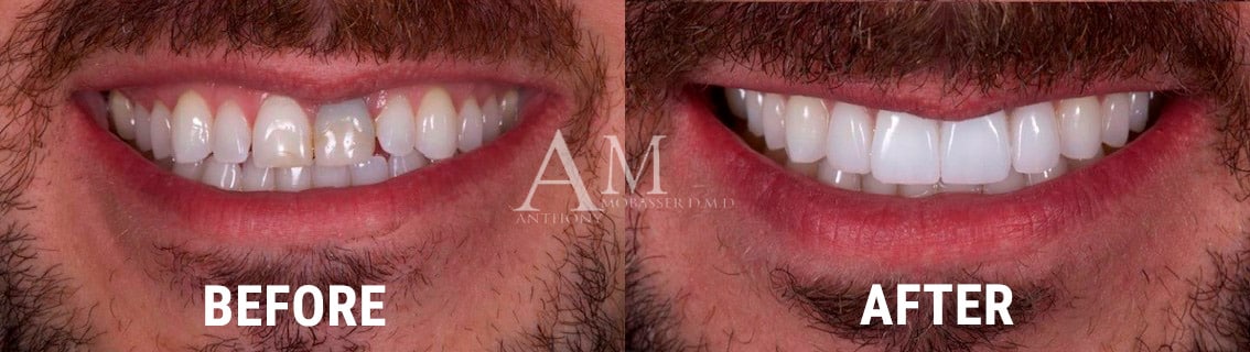Coronas dentales en Los Ángeles: antes y después de las coronas dentales