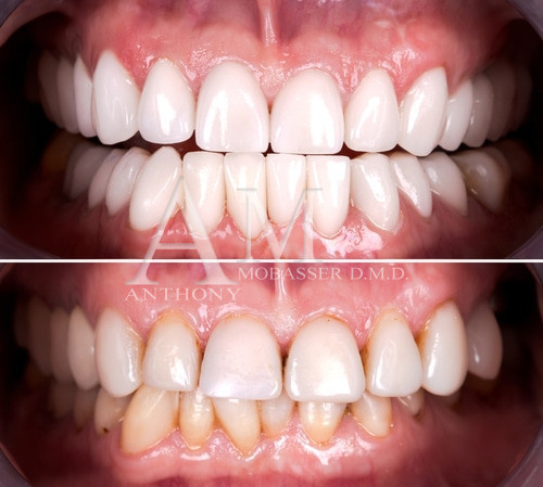 Dental-Reconstruction-in-Los-Angeles-CA-Dr.-Anthony-Mobasser-Dentiste-cosmétique