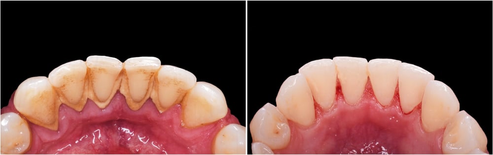 Tratamientos de la enfermedad periodontal o de las encías