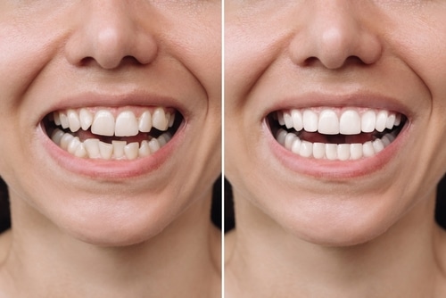 Retrouver le sourire grâce à son dentiste