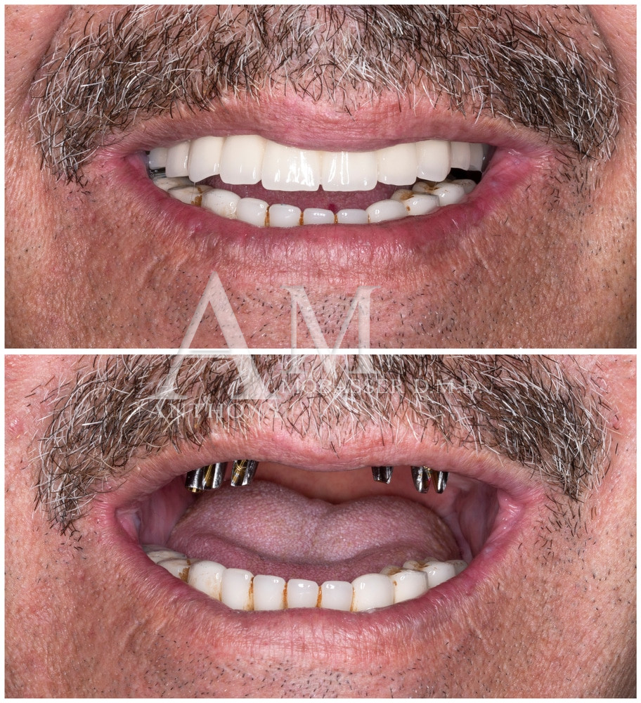 Full Mouth Reconstruction Los Angeles