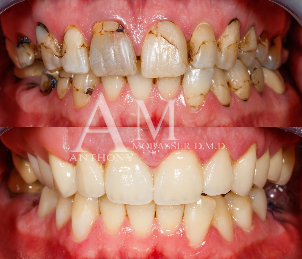 Smile Makeover Los Angeles