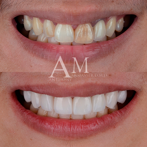 Porcelain-Veneers-Los-Angeles---Before-and-After-Veneers