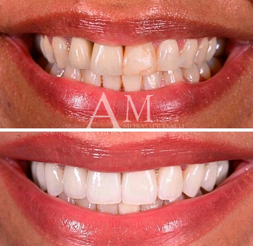 orthodonics-with-porcelain-veneers-in-los-angeles