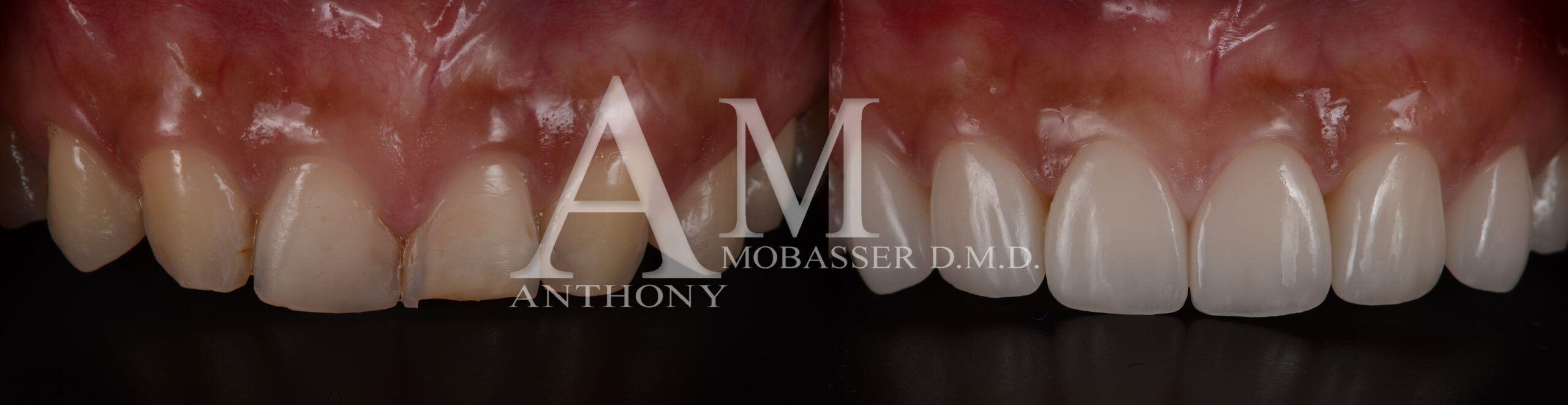 Transformation des facettes en porcelaine sur les dents endommagées par le reflux acide