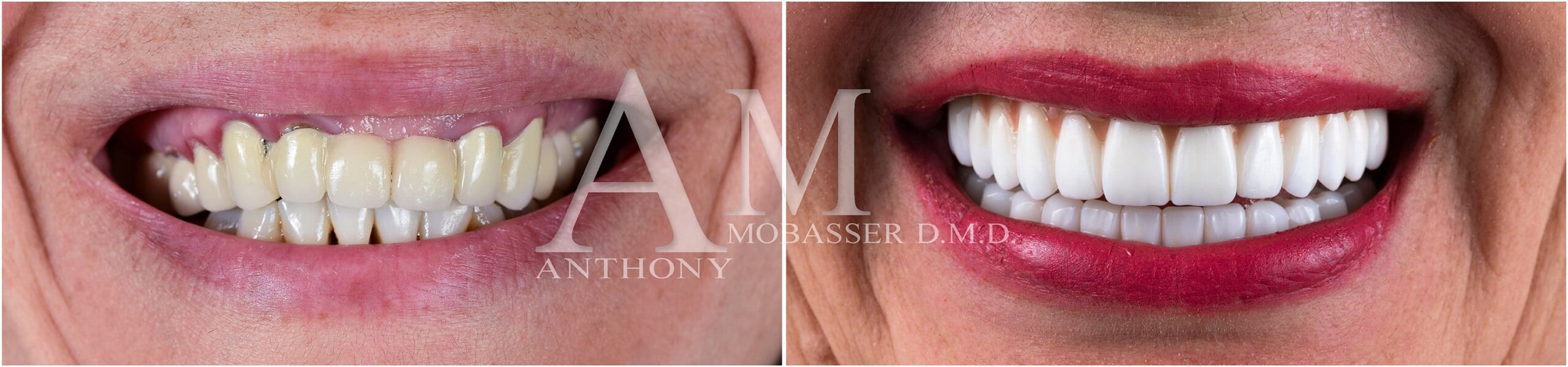 Restauration du sourire et de l'occlusion De l'inconfort à un sourire confiant