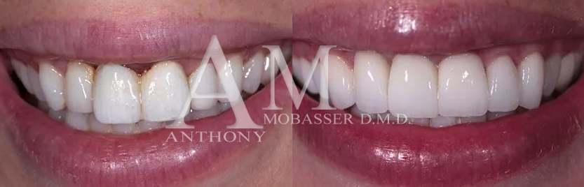 Anthony Mobasser DMD West Hollywood Cosmetic Dentist