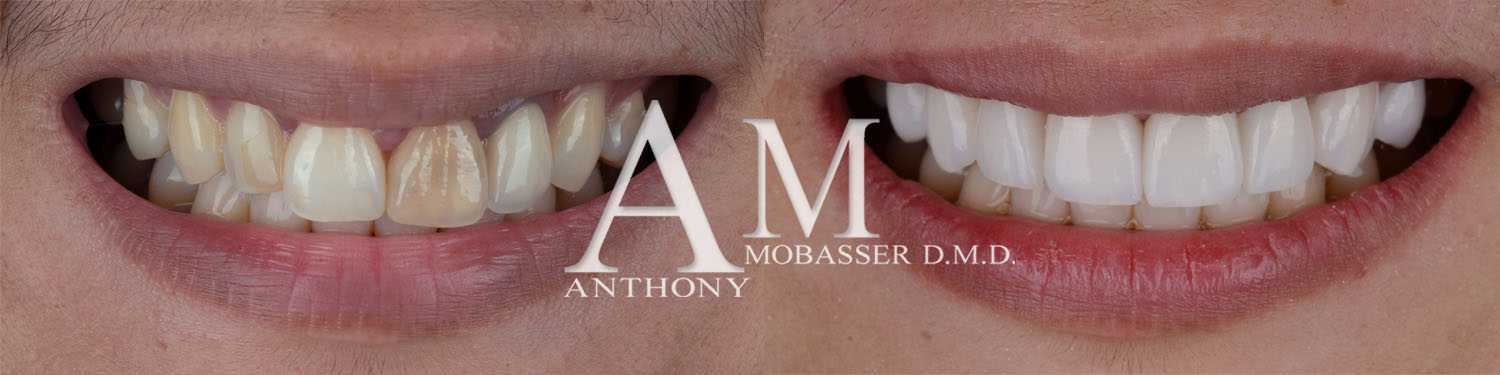 Cosmetic Dentist in Brentwood | Dr. Anthony Mobasser