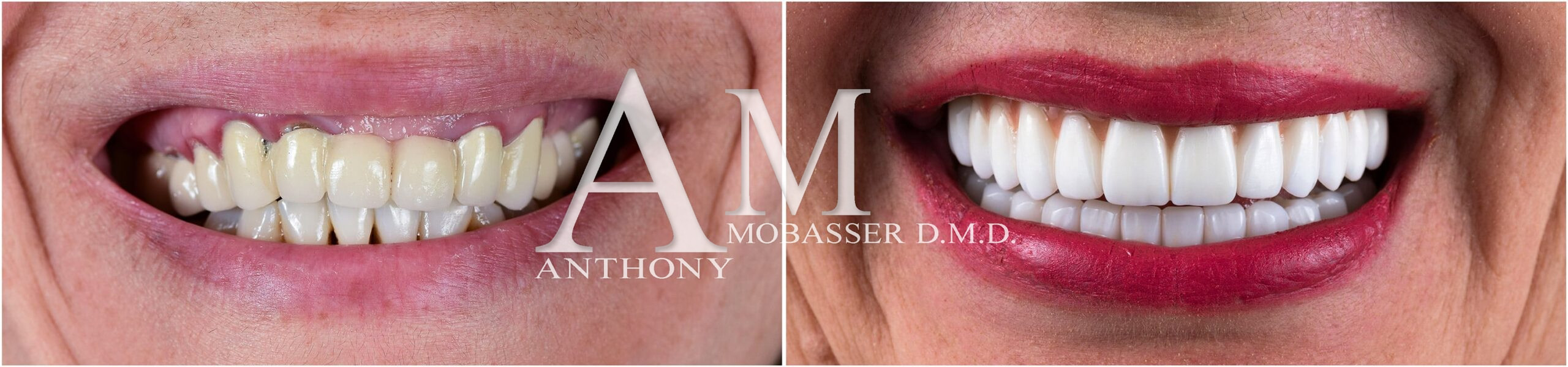 全球最佳美容牙医 | Anthony Mobasser 博士