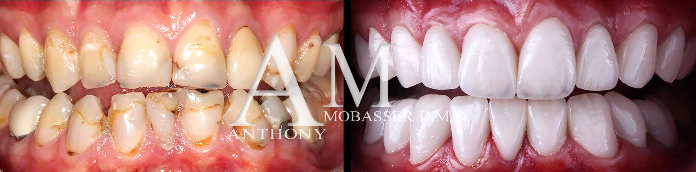 Il miglior dentista estetico del mondo | Dr. Anthony Mobasser