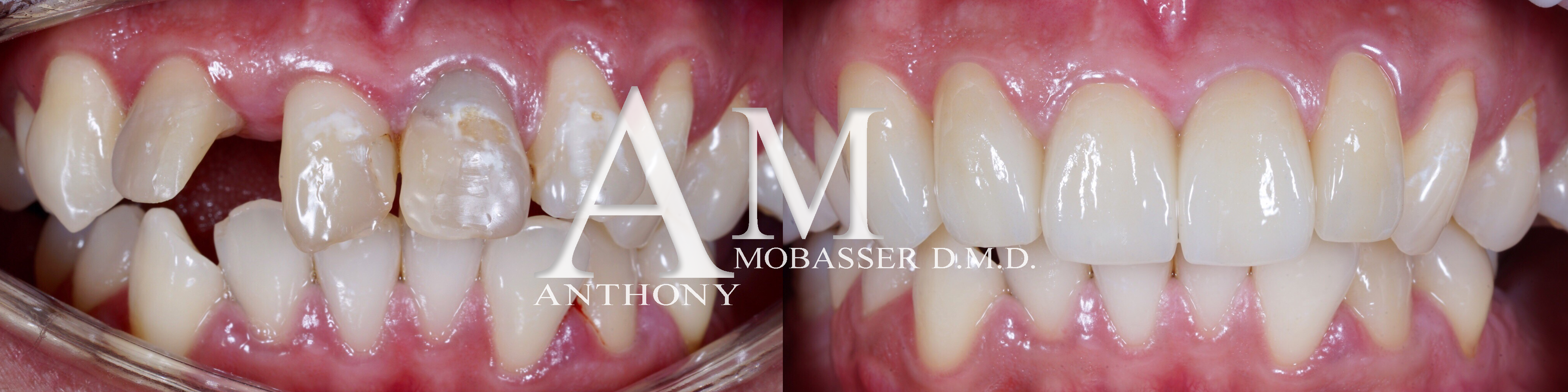 Meilleur dentiste esthétique au monde - Dr. Anthony Mobasser