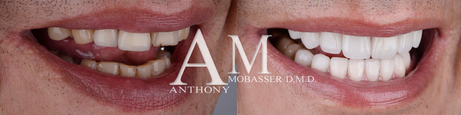 Dentiste esthétique à Westwood | Dr. Anthony Mobasser