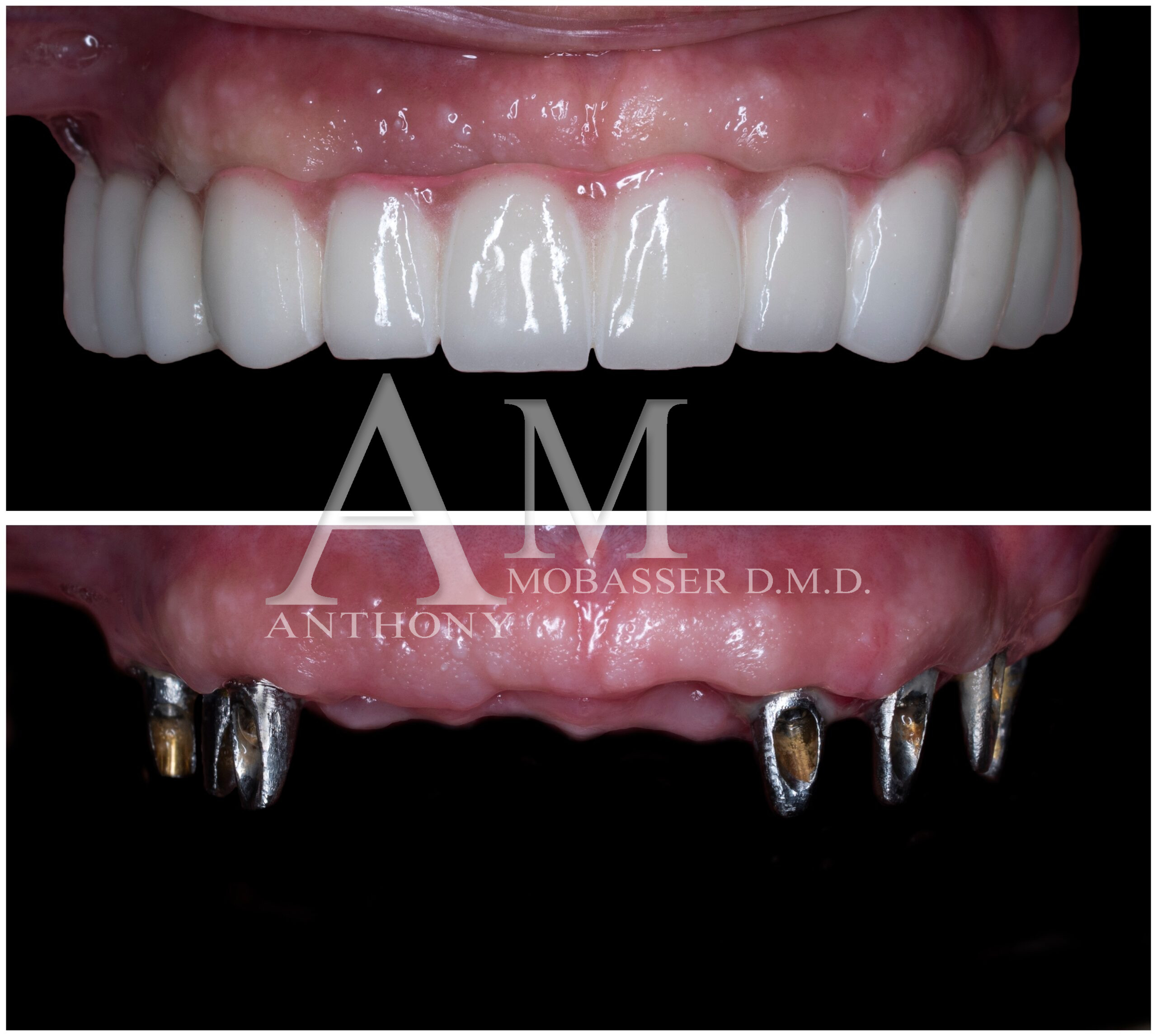 Implantes Dentales en Los Angeles | Dr. Anthony Mobasser