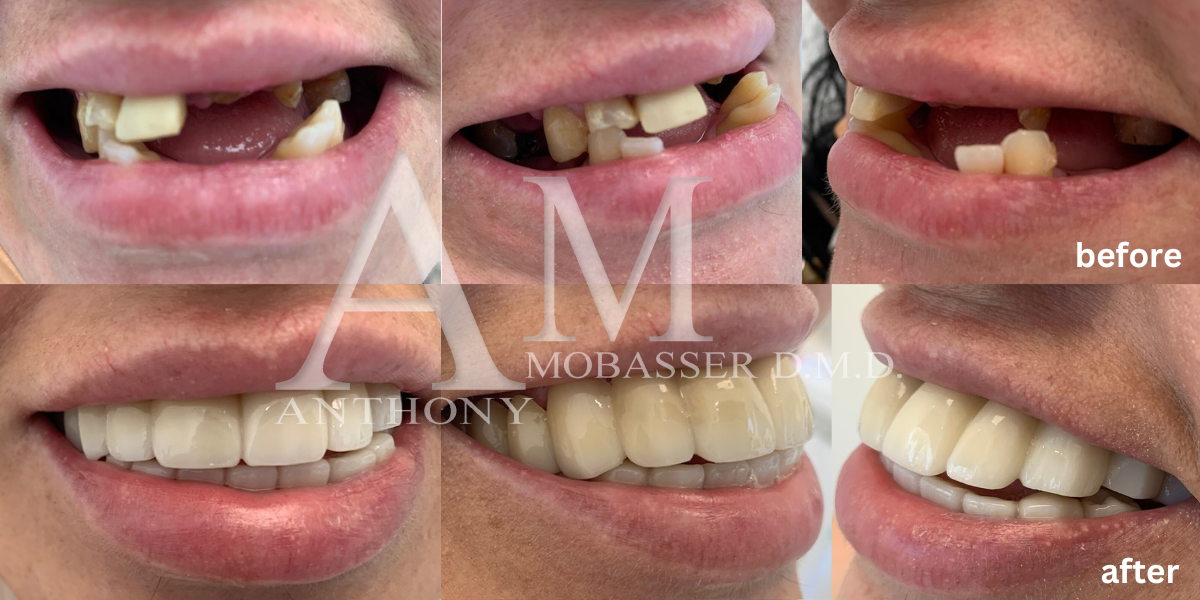 Snap on Smile en Los Angeles | Dr. Anthony Mobasser