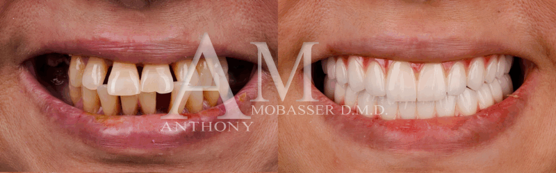 All on 6 Dental Implants Before and After | Dr. Anthony Mobasser