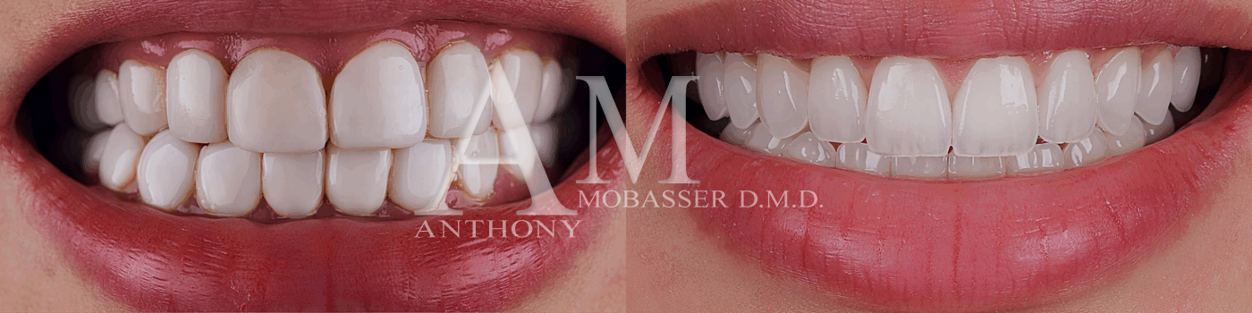Composite Veneers vs. Porcelain Veneers | Smile Makeover Before and After