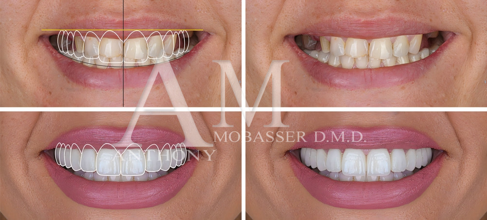 Full Mouth Reconstruction | Zirconia Veneers in Los Angeles, CA