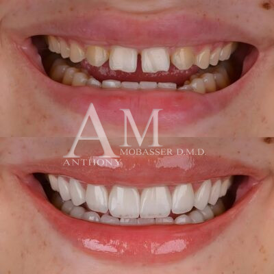 Lumineers Before and After | Best Beverly Hills Cosmetic Dentist