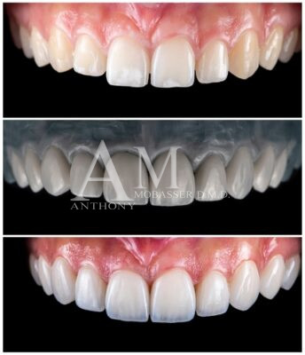 Lumineers Candidate | No Prep Veneers in Los Angeles, CA