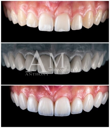 No Prep Veneers Before and After | Los Angeles Cosmetic Dentist