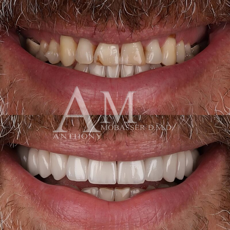 Porcelain Veneers Before and After | Smile Makeover in Los Angeles, CA