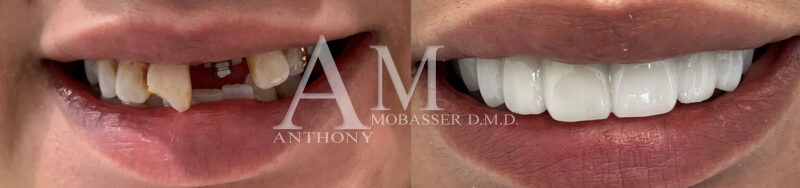 Snap-On Veneers Before and After | Celebrity Dentist Dr. Anthony Mobasser