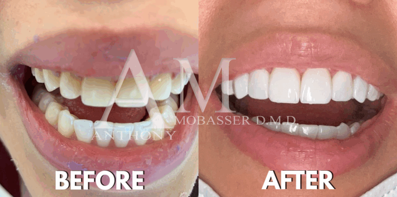 No Prep Veneers in Los Angeles | Micro Veneers Before and After