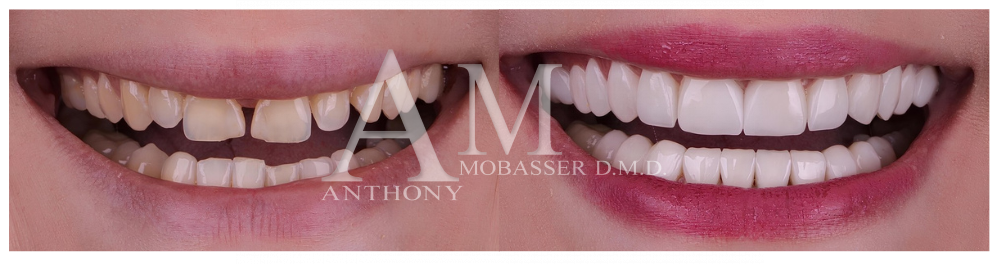 Minimal Prep Veneers in Los Angeles, CA | Thin Veneers