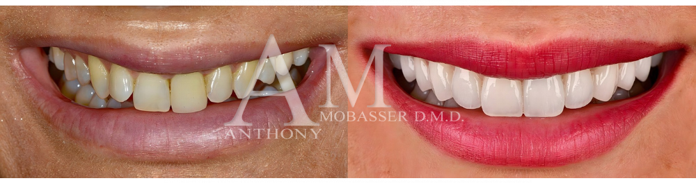 Smile Makeover in Beverly Hills, CA | Best Porcelain Veneers Near Me