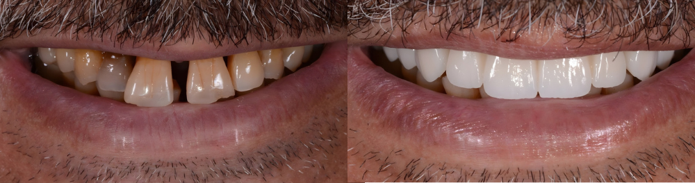 Odontología cosmética en Beverly Hills | Transformación de la sonrisa: antes y después