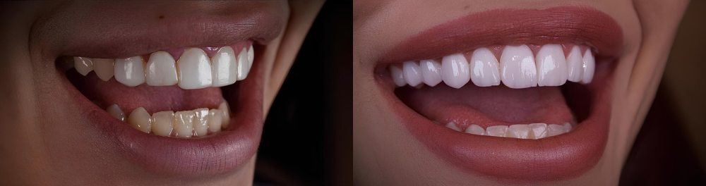 Dental Bonding in Los Angeles | No-Prep Composite Veneers