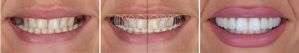 Reconstrucción bucal completa en Beverly Hills | Da Vinci Smile Design
