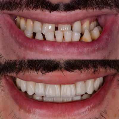 Full Mouth Reconstruction in Beverly Hills | Smile Makeover Before and After