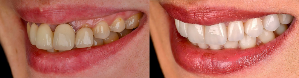 Tratamiento de la sonrisa gingival en Beverly Hills | Antes y después
