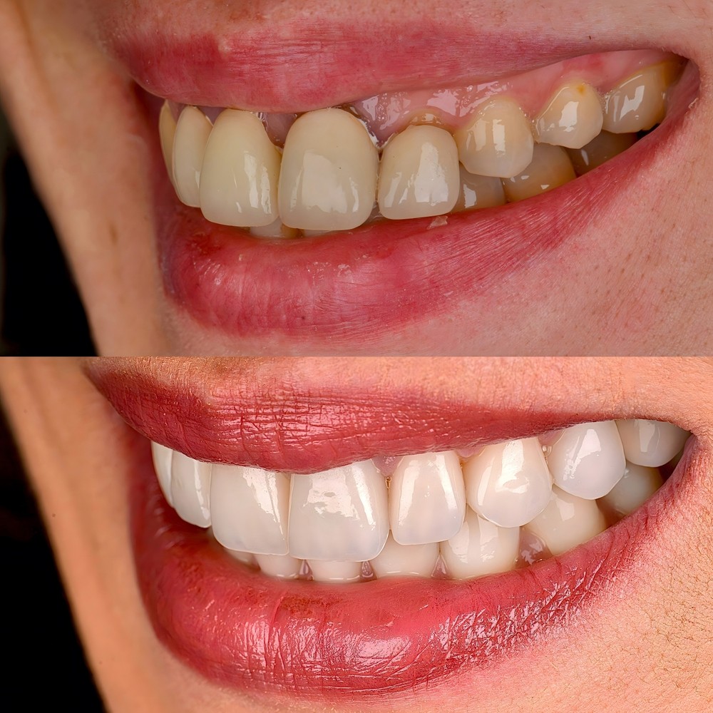 Gummy Smile Treatment in Los Angeles | Before and After Gallery