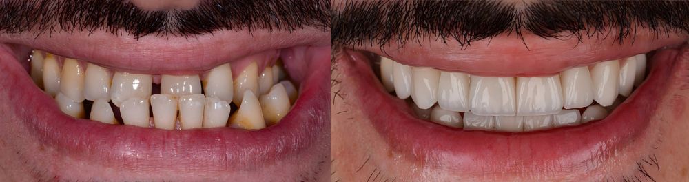 Transformación de la sonrisa en Los Ángeles | Corrección de la mordida inversa