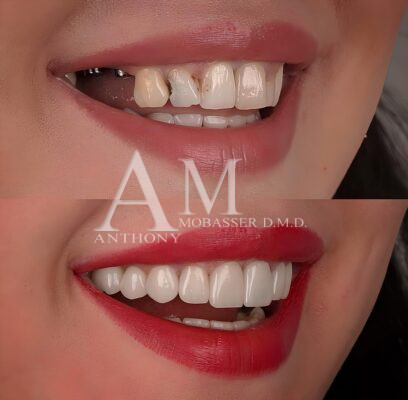 Transformación de la sonrisa con carillas de porcelana en Beverly Hills, California | El Dr. Anthony Mobasser, dentista de las celebridades