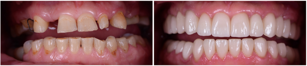 TMJ Treatment in Los Angeles | Bruxism and TMJ Pain